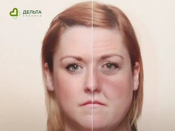 Две половины лица женщины с видимыми признаками алкогольного отёка